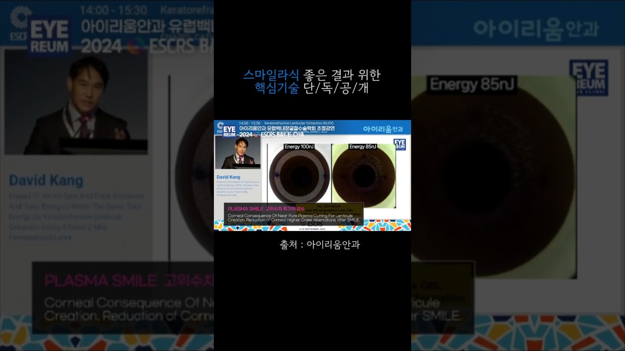 [艾利姆眼科診所] SMILE雷射 優異成果的關鍵技術 獨家公開 #艾利姆眼科 #SMILE雷射PRO #等離子SMILE
