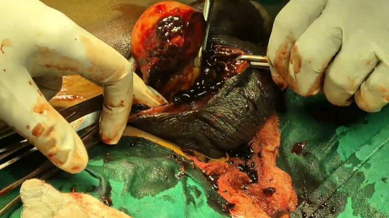 Scrotal Haematocele operation