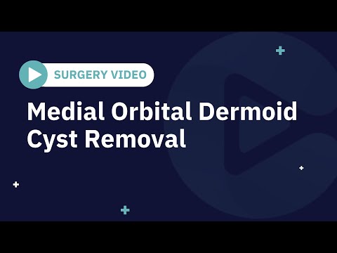 Surgery Video: Medial Orbital Dermoid Cyst Removal - video from CSurgeries