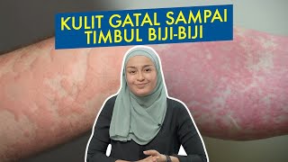 Kulit Gatal Sampai Timbul Biji-Biji Kulit Gatal Sampai Timbul Biji-Biji