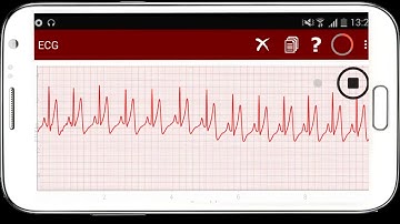 ECG Capturing single lead