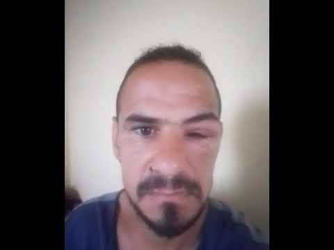 تورم العين بسبب لسعة نحل ماهو علاجه إخوتي