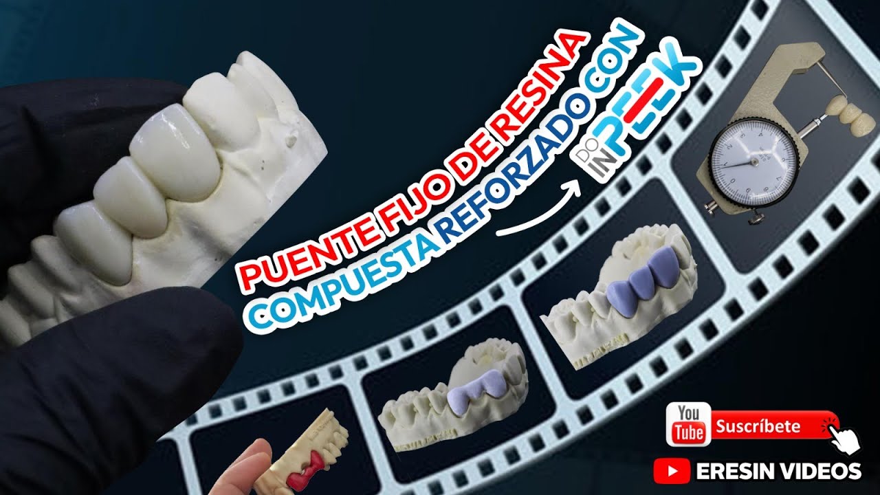 PUENTE  FIJO DE RESINA REFORZADO CON DO IN PEEK #dentaduras #dientes #protesisdental #dentista