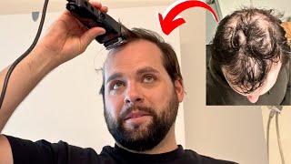 I Tried EVERYTHING For BALDING - Head Shave TRANSFORMATION