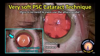 CataractCoach 1100: technique for very soft PSC cataract surgery screenshot 1