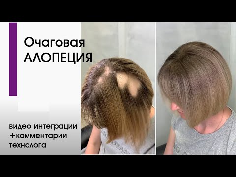 Лекция по теме Очаговая алопеция