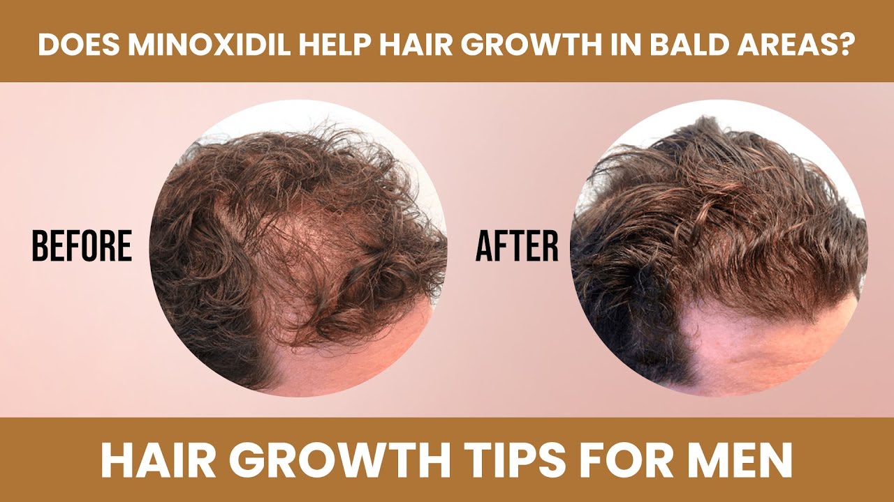does-minoxidil-help-hair-growth-in-bald-areas-hairfall-hair-growth