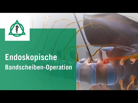 Endoskopische Bandscheiben-Operation | Asklepios