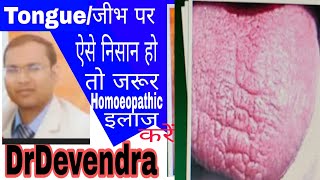 जीभ देखकर होमियोपैथिक मेडिसिन लेना/oleander 200 200 Oleander St