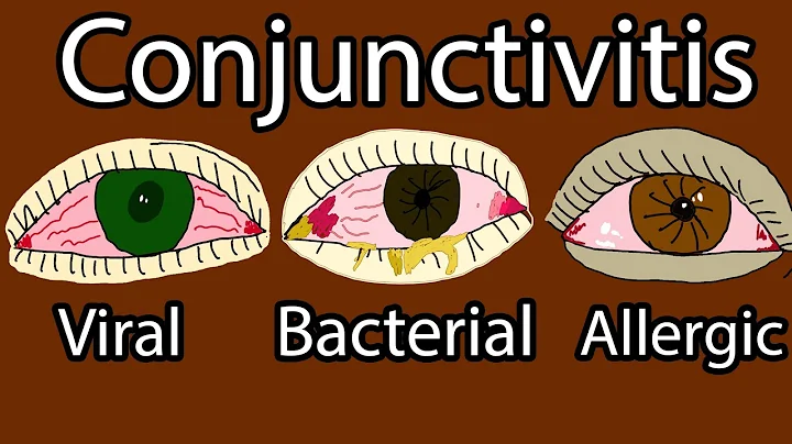 Pink Eye (Conjunctivitis) - Viral, Bacterial and allergic conjunctivitis. Symptoms and treatment - DayDayNews