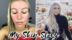 HOW I CURED MY ACNE ROSACEA, BEFORE & AFTER, MY SKIN STORY, REDNESS, ACNE TREATMENT |Scarlett London