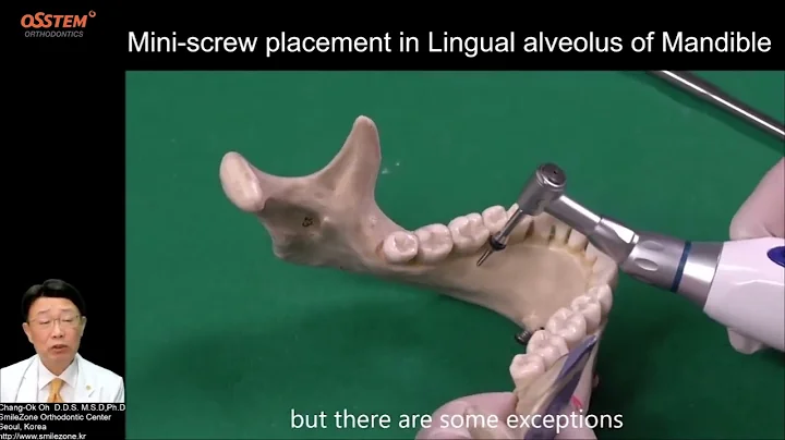 11  Lingual side of Mandibular When and How to use  Orthodontic Screw