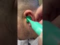 Part Two: Take the impression! #audiologist #earwax #satisfying #asmr #earimpression #audiology