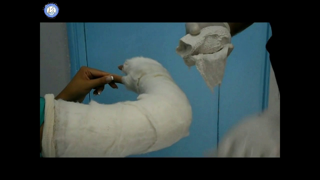 confection d'un plâtre - YouTube