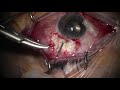 Ahmed Glaucoma Valve Implantation in a Recently-Ruptured Globe