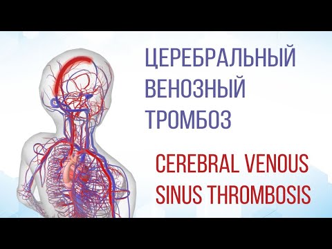 Церебральный венозный тромбоз / Cerebral Venous Sinus Thrombosis