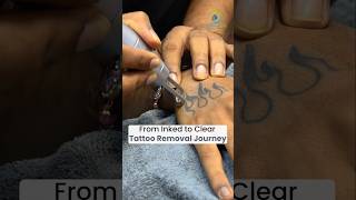 1St Session Tattoo Removal Best Tattoo Removal Clinic In Delhi Dr Gaurav Garg