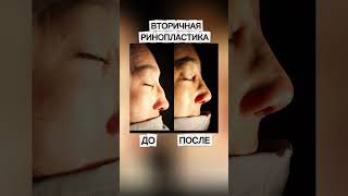 Вторичная ринопластика. Горбатый, кривой и седловидный нос. Деформация носа устранена.