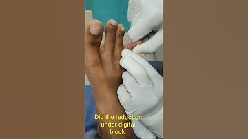 Toe Dislocation Emergency reduction | Toe injuries treatment | Adamya Hosp Videos