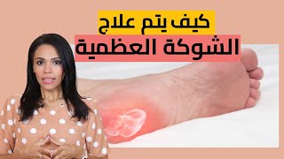 كيف يتم علاج الشوكة العظمية