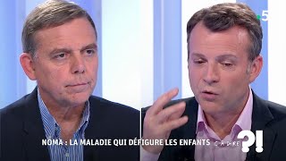 Noma : la maladie qui défigure les enfants #cadire 29.06.2018