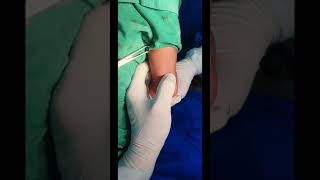 Ctev Corrective Surgery Adamya Hospital Videos
