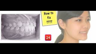 Pseudo Class III Treatment!