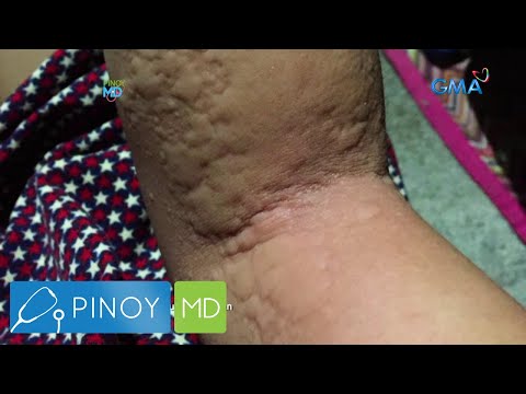 Pinoy MD: Labis na pamamantal, sanhi ng urticaria?