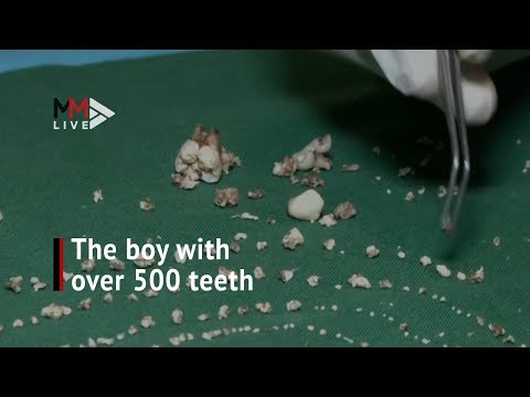Wideo: Siedmioletni Chłopiec Miał Guz Z 526 „zębami” Usuniętymi Z Dolnej Szczęki - - Alternatywny Widok