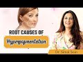 Root causes of hyperpigmentation  best hyperpigmentation solutions  aayna clinic