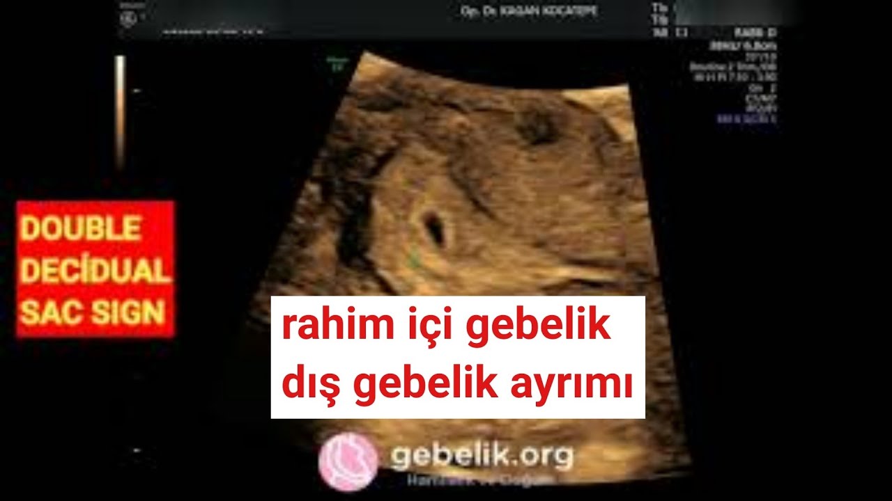 gebelik ilk uc ayinda yapilan ultrason