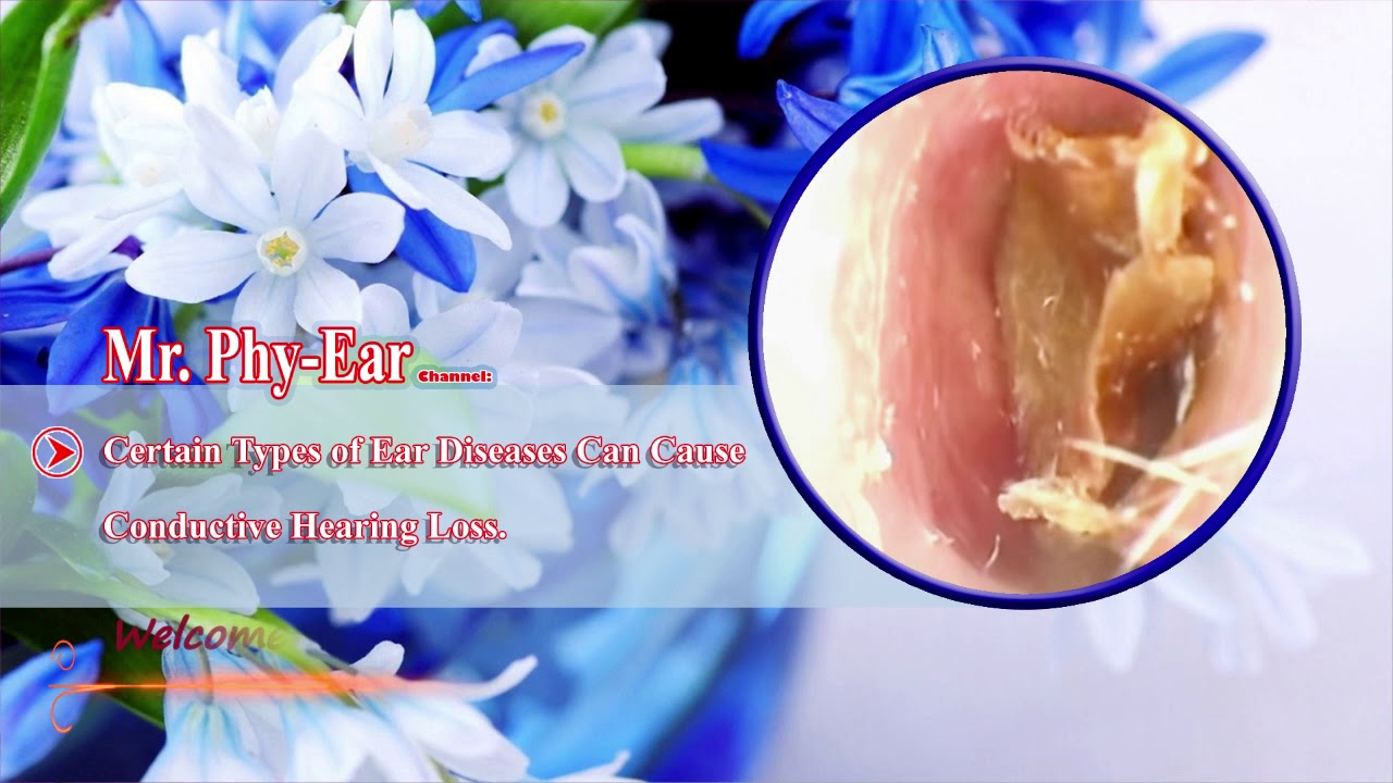 cholesteatoma tympanosclerosis 4 YouTube