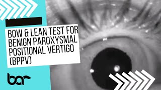 Bow and Lean Test During Right Horizontal Canal BPPV, Cupulolithiasis-type