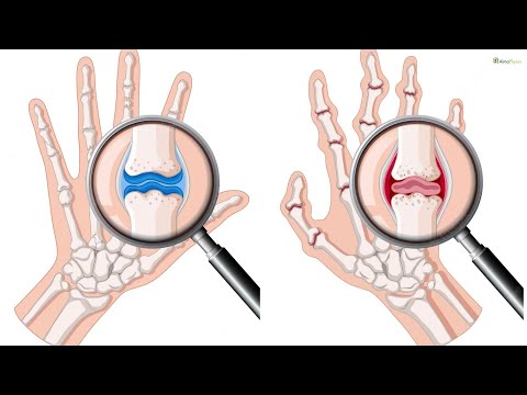 Video: 3 modi per prevenire la progressione dell'artrite