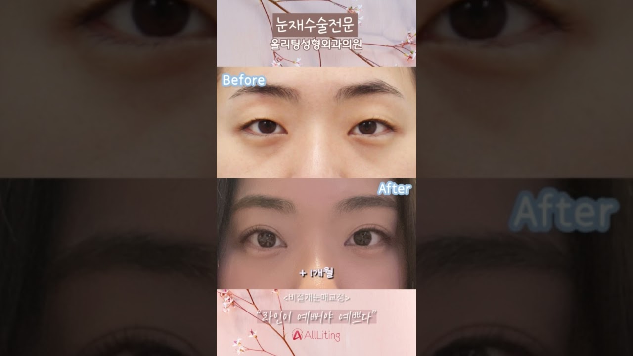 [奧麗婷整形外科診所] 看一眼👀就覺得漂亮👍❤️ #非切開提眼肌矯正 #非切開提眼肌矯正效果 #非切開提眼肌矯正專家 #擅長半外雙眼皮 #半外雙眼皮專業診所 #江南 #整形外科