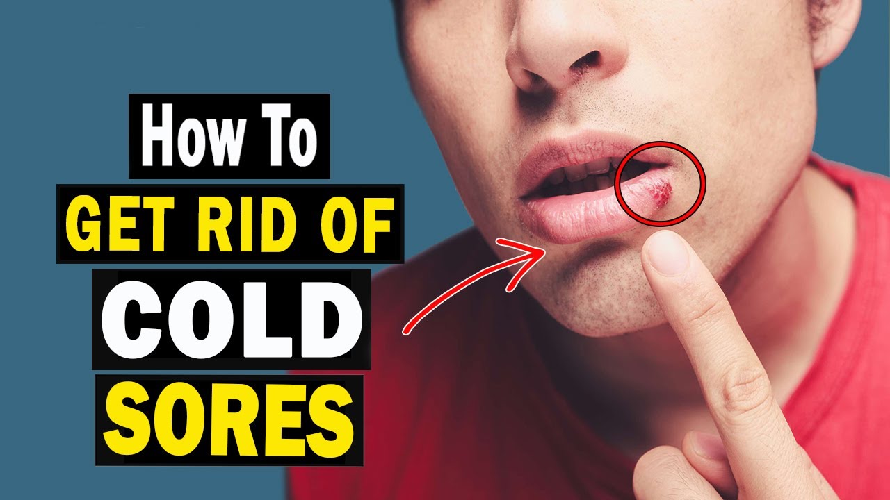 How to Treat Cold Sores Naturally Fever Blisters Home Remedies