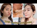 MELASMA, Dark Patches, Uneven Skin Tone! PANO MAWALA 'SKIN1004 3Weeks REVIEW'