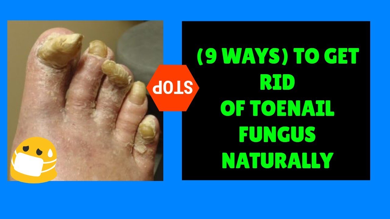 How To Get Rid of Toenail Fungus Naturally (9 WAYS) To