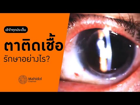 วีดีโอ: 5 วิธีในการรักษาตาติดเชื้อโดยธรรมชาติ