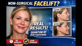 Non-Surgical Facelift My REAL 1-Week Results with Quantum RF (Jawline + Neck Tightening)