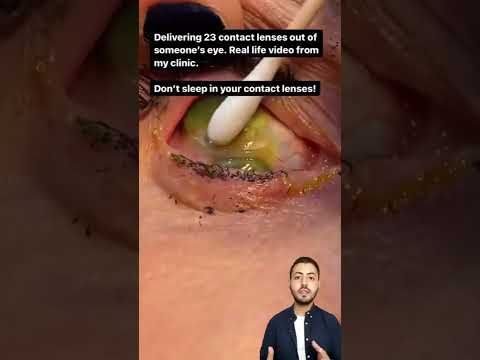 امرأة تضع 23 عدسه لاصقه في عين واحده أخبار 