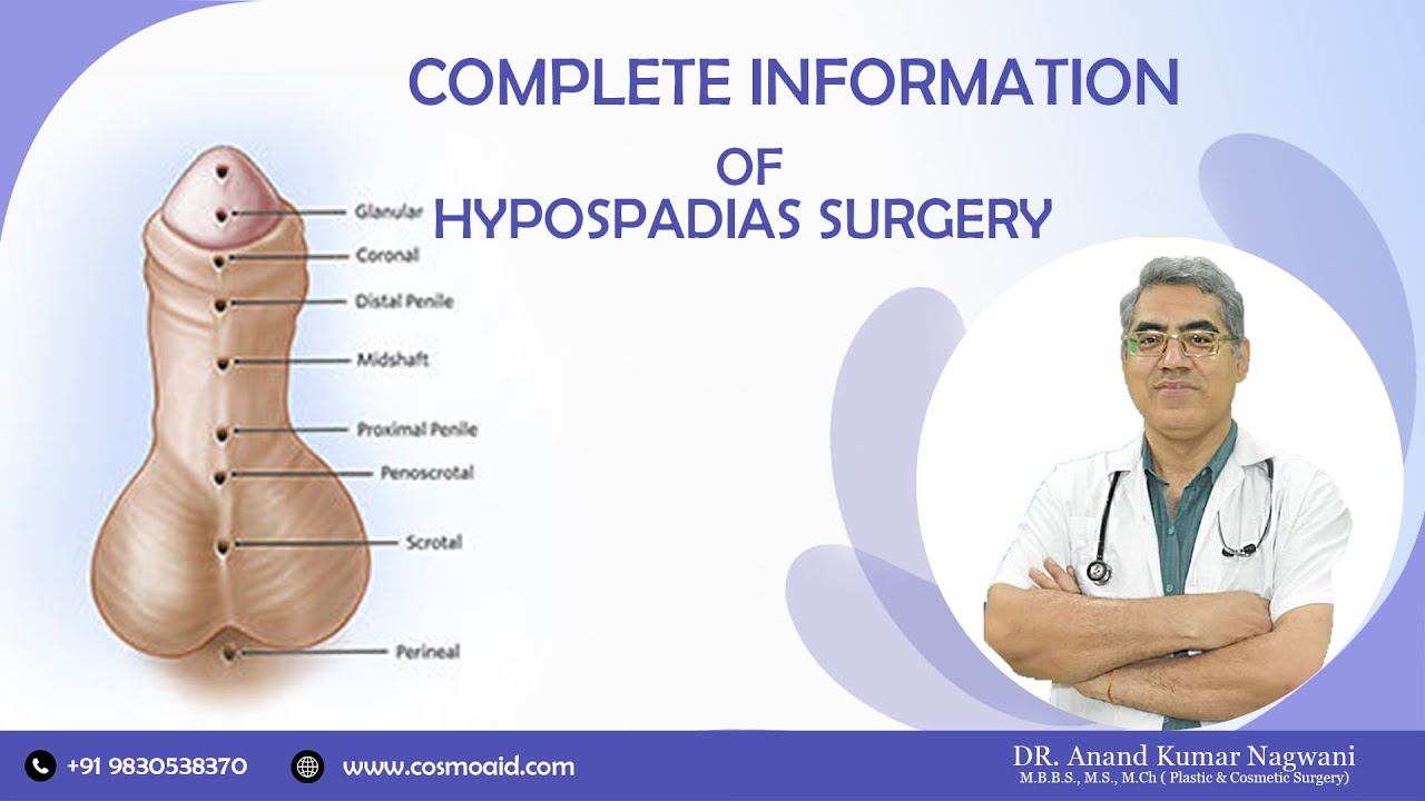 Hypospadias Surgery | Complete Information of Hypospadias Problem & Solution | By Dr. A. K. Nagwani