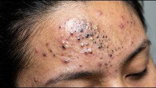 Blackhead Removal | Huge Blackheads Removed from Nose