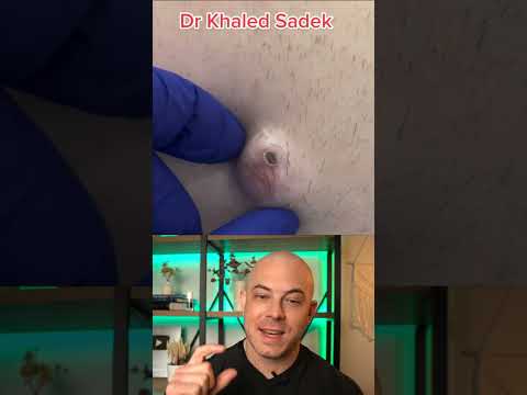 Doctor reacts to MASSIVE cyst! #dermreacts #doctorreacts #pimplepop #cystpop