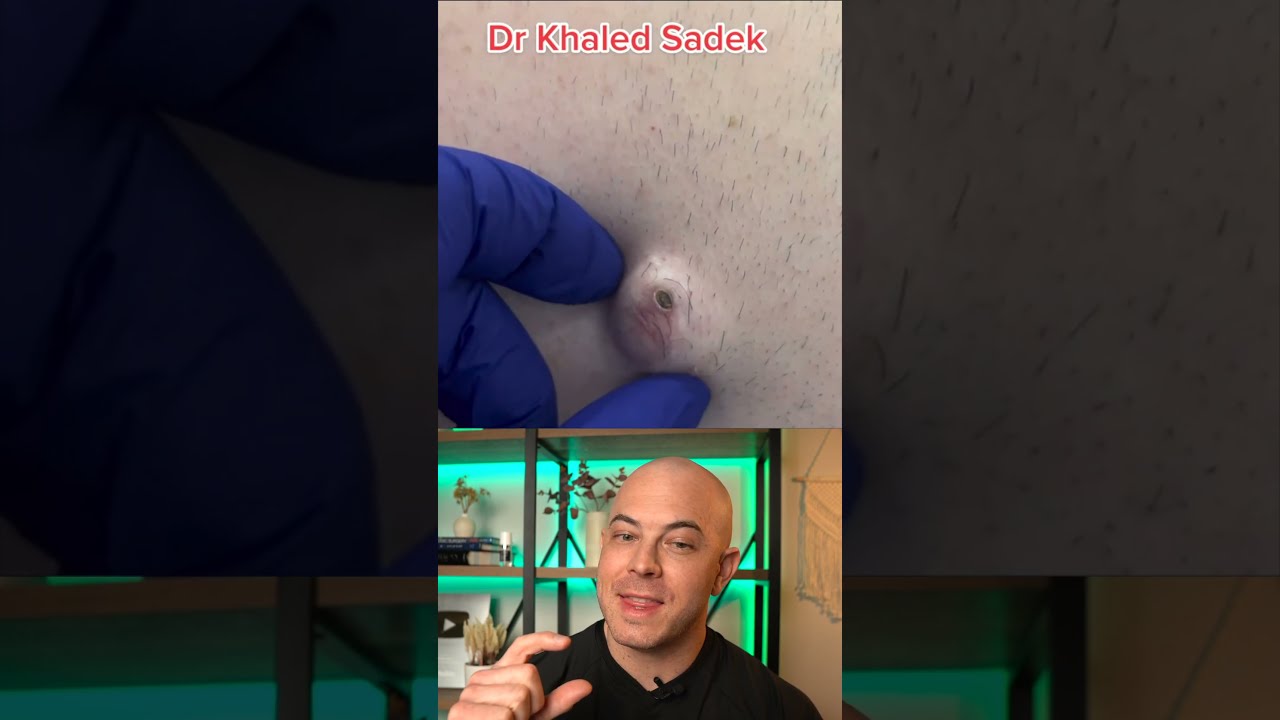 Doctor Reacts To MASSIVE Cyst Dermreacts Doctorreacts Pimplepop Cystpop