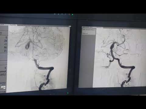 Fusiform basilar artery partial flow diversion