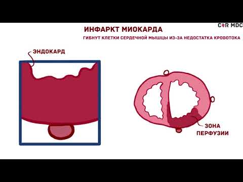 Инфаркт миокарда причины, патофизиология, симптомы, ЭКГ