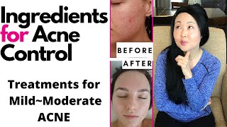 Ingredients for ACNE and OILY skin: ACNE TREATMENT for MILD Acne