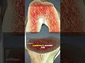 Total Knee Replacement Surgery (3DAnimation)