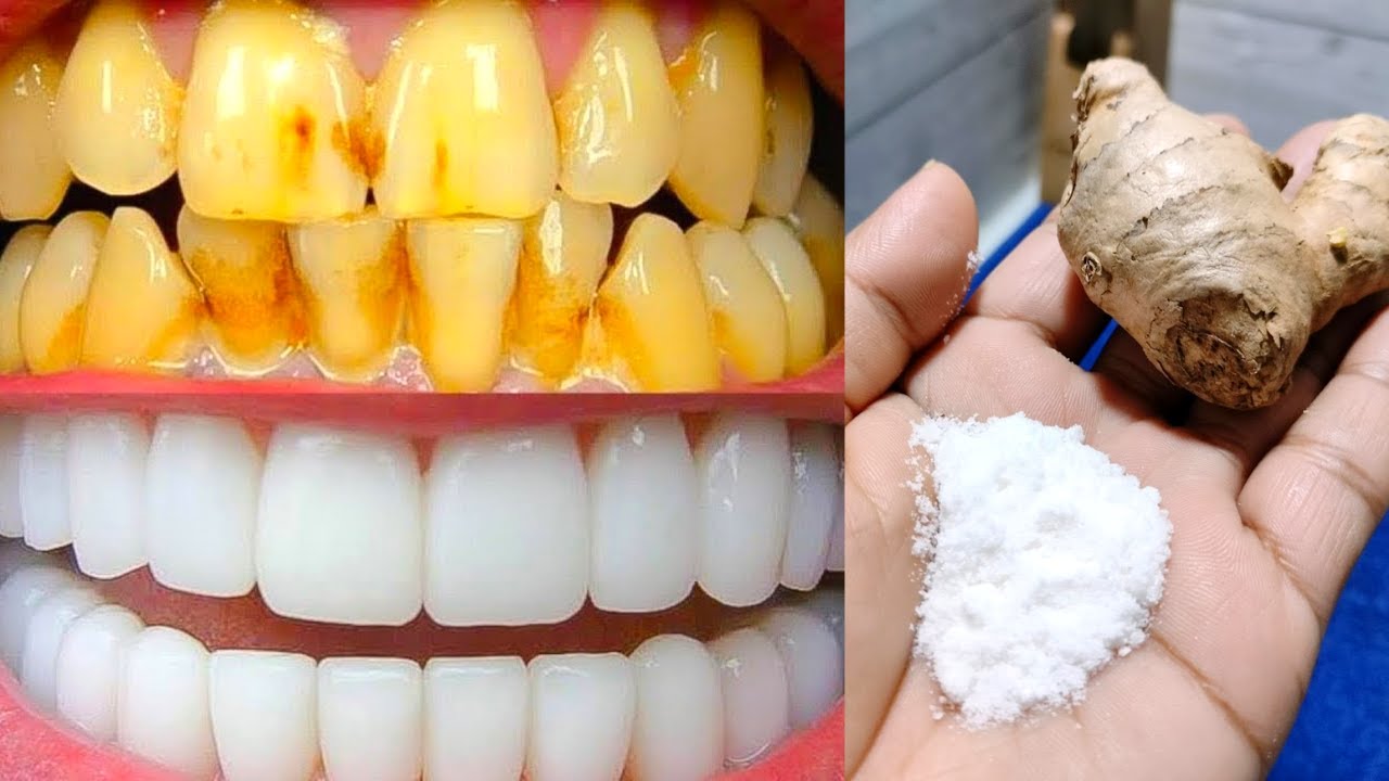 सिर्फ 2 मिनट में गंदे पीले दांतो को मोती की तरह चमका देगा यह नुस्खा